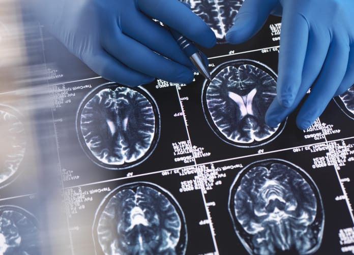 Photo shows a doctor reviewing MRI scans of the brain/Getty Images