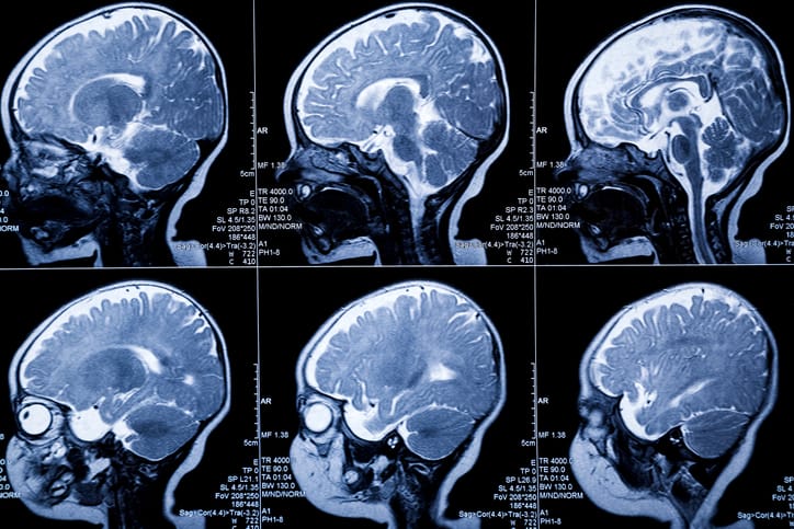 A photo shows the results of an infant's brain scan/Getty Images